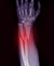 Bone Fractures